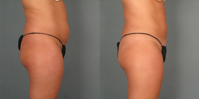 Tummy Tuck before and after photo