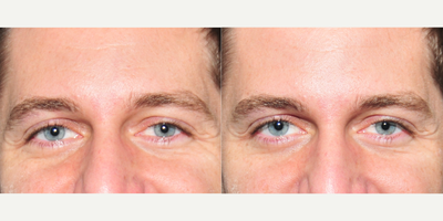 Botox before and after photo