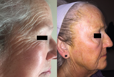 Chemical Peel before and after photo