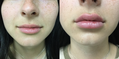 Lip Fillers before and after photo