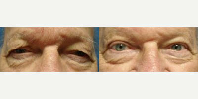 Eyelid Surgery before and after photo
