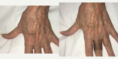 Hand Rejuvenation before and after photo