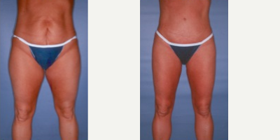 Liposuction before and after photo