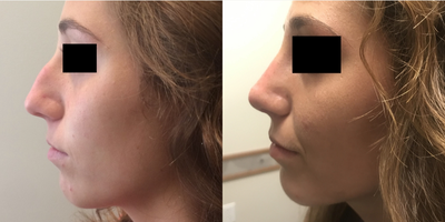Revision Rhinoplasty before and after photo