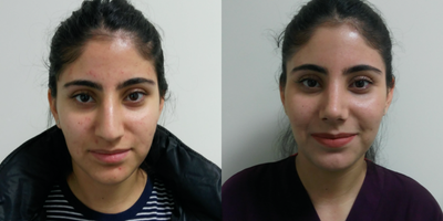 Rhinoplasty before and after photo