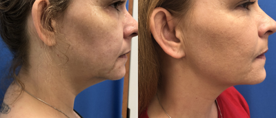 Botox before and after photo