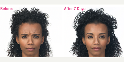Botox before and after photo