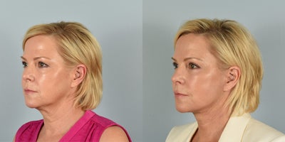 Eyelid Surgery before and after photo