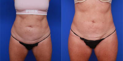 Liposuction before and after photo