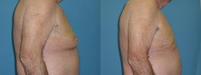 Liposuction before and after photo