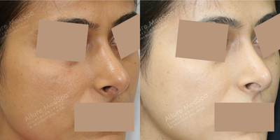 Rhinoplasty before and after photo