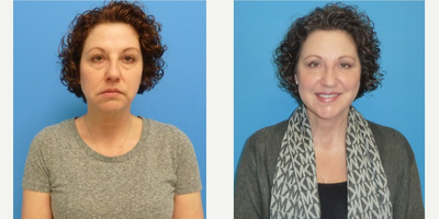 Eyelid Surgery before and after photo