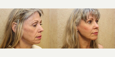 Facelift before and after photo