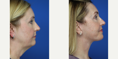 Facelift before and after photo
