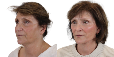 Lip Fillers before and after photo