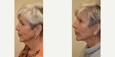 Lower Facelift before and after photo