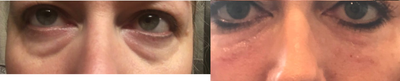 Restylane Lyft before and after photo