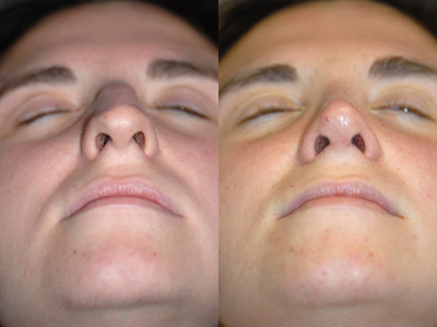 Asian Rhinoplasty before and after photo