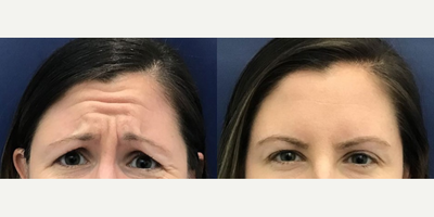 Botox before and after photo