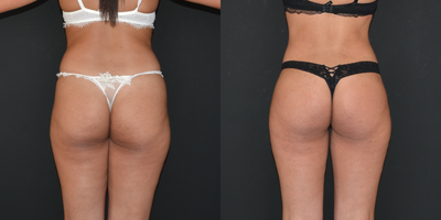 Brazilian Butt Lift before and after photo