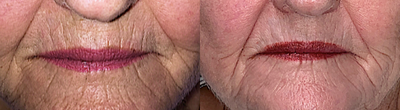 CO2 Laser before and after photo