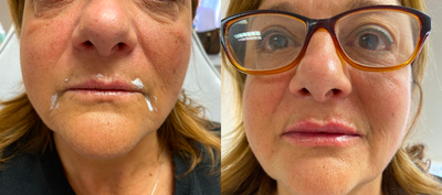 Dermal Fillers before and after photo