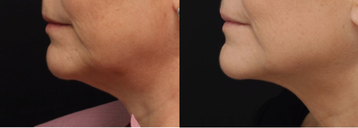 Microneedling before and after photo
