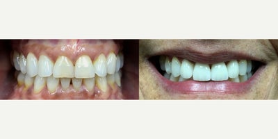 Smile Makeover before and after photo