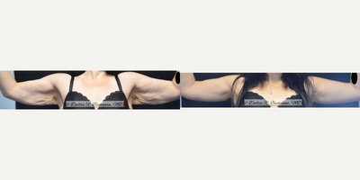 Arm Lift before and after photo