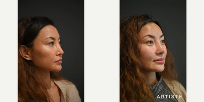Asian Rhinoplasty before and after photo