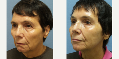 Facelift before and after photo