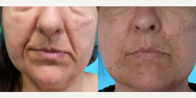 Facial Fat Transfer before and after photo