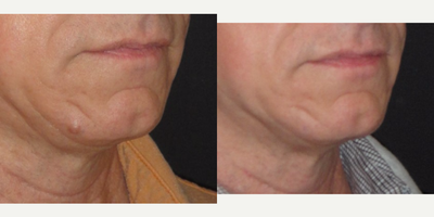 Mole Removal before and after photo