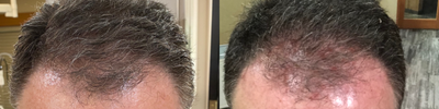 PRP for Hair Loss before and after photo