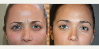 Botox before and after photo