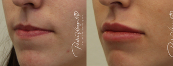 Lip Fillers before and after photo