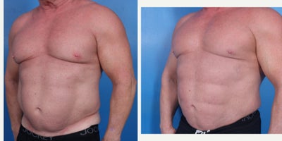 Power-Assisted Liposuction (PAL) before and after photo