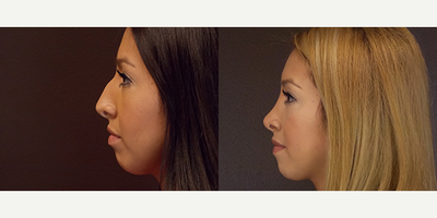 Rhinoplasty before and after photo