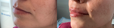 Juvederm before and after photo