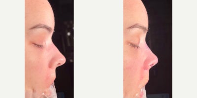Rhinoplasty before and after photo