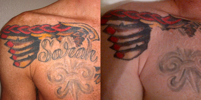 Tattoo Removal before and after photo