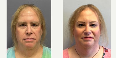Brow Lift before and after photo