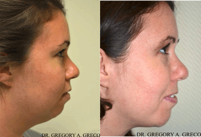 Chin Implant before and after photo