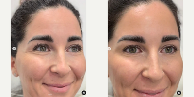 Dysport before and after photo