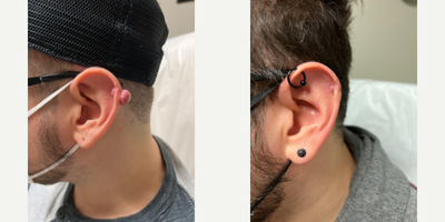 Ear Surgery before and after photo