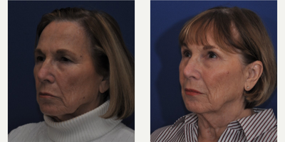 Facelift before and after photo