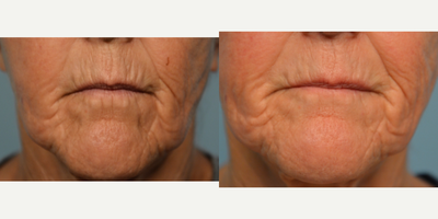 Morpheus8 before and after photo