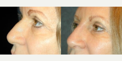 Nonsurgical Nose Job before and after photo