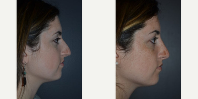 Rhinoplasty before and after photo