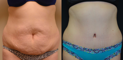 Tummy Tuck before and after photo